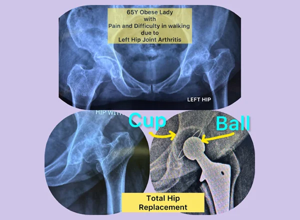 Total Hip Replacement
